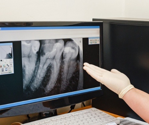 Dentist pointing to screen showing digital dental x rays