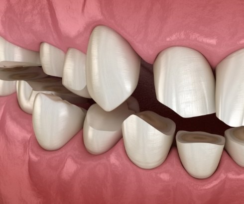 Animated teeth worn down from occlusal disease in Portland