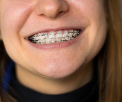Close up of smile with traditional braces
