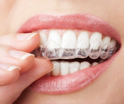 Close up of person placing a clear aligner over their teeth