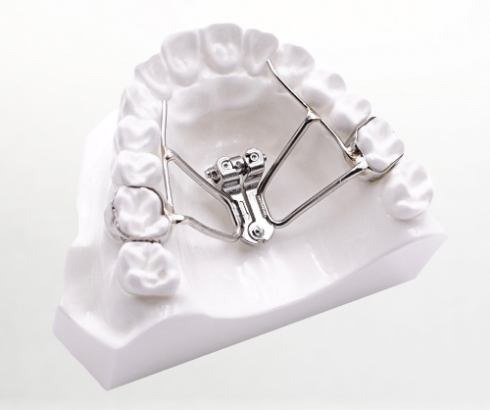Palatal expander on model of upper dental arch
