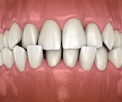 Animated close up of misaligned teeth before traditional braces in Portland