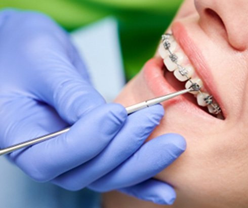Orthodontist using special tool to place bracket on tooth