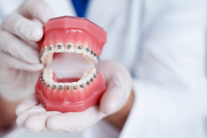 Dentist holding a dental model that has braces